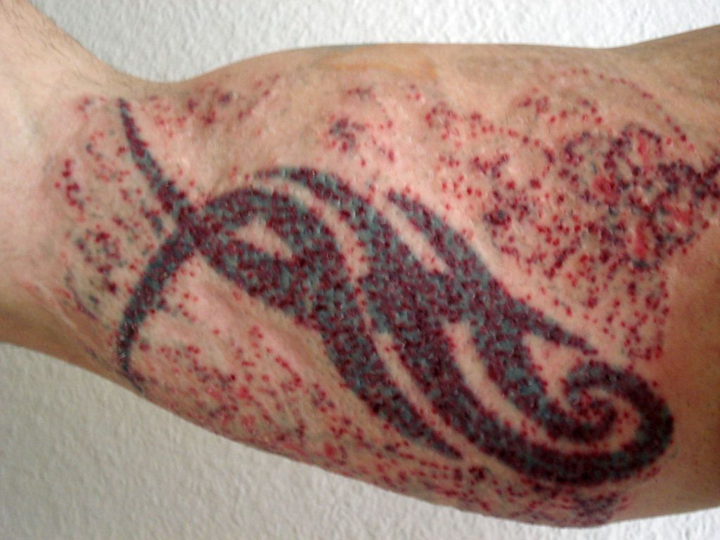 Wieder Eine Neue Laser Sitzung Tattoo Bewertungde