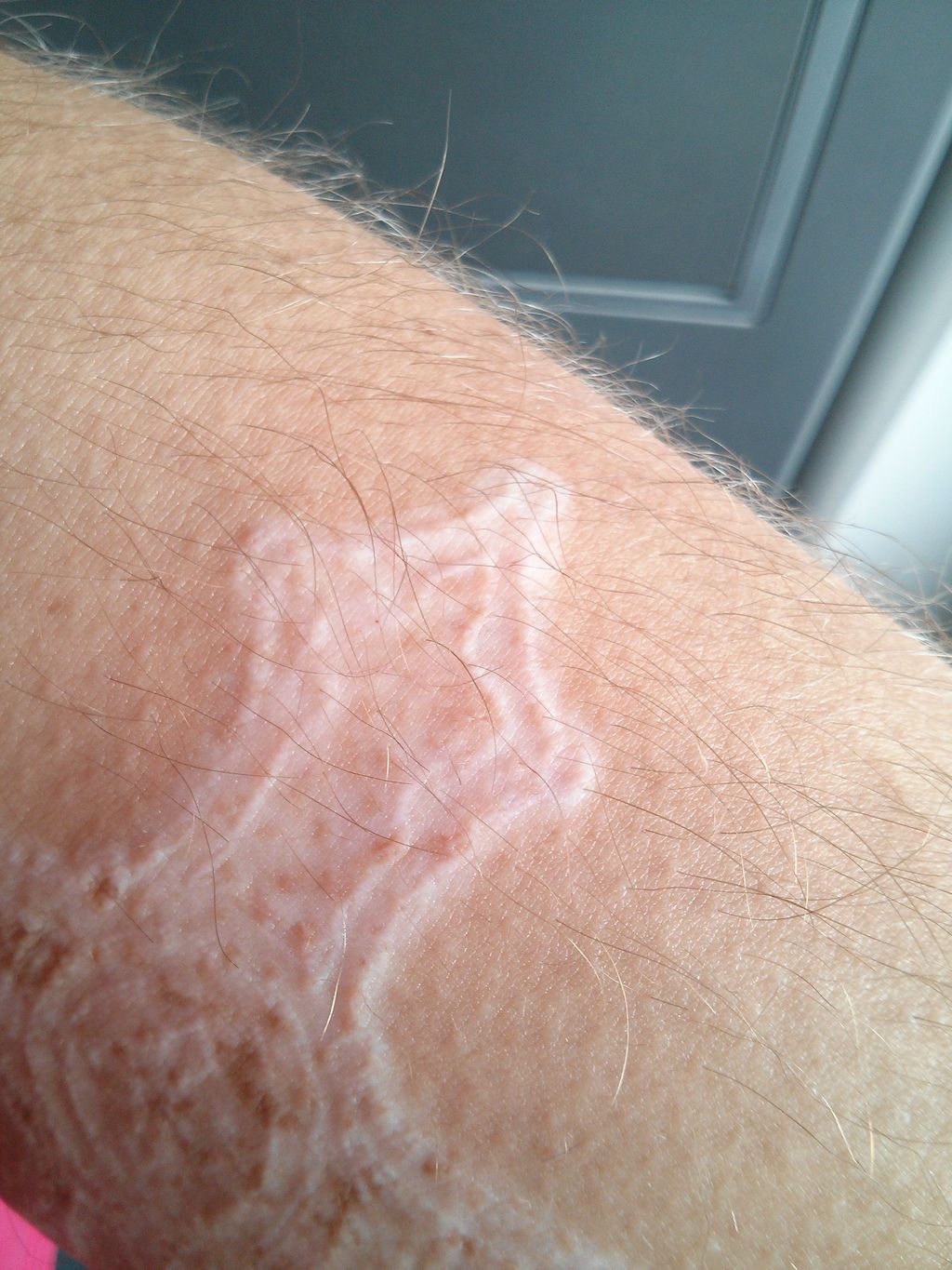 Noxx: Narbe vom Lasern - ob man die gut covern kann?