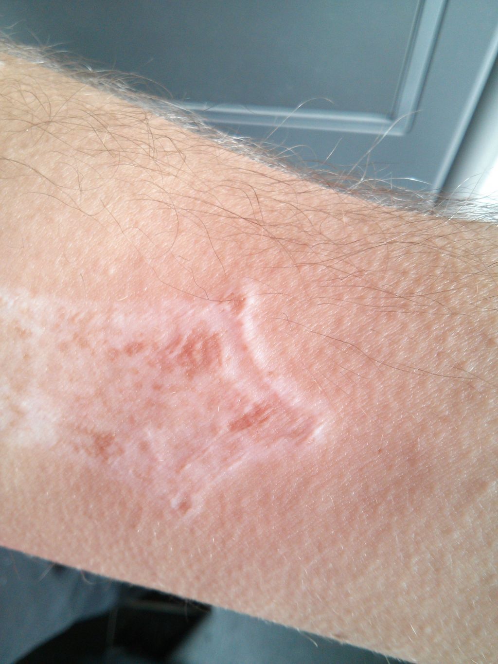 Narbe vom Lasern ob man die gut covern kann? TattooBewertung.de