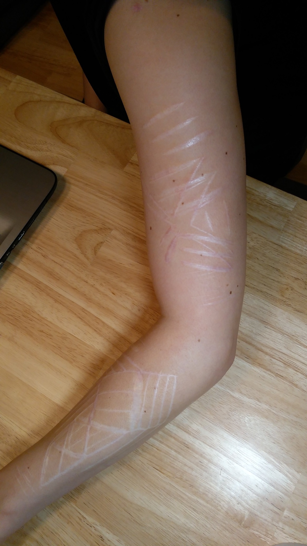 Tattoo & Tiefe Narben&hellip;Rat & Empfehlungen von Euch | Tattoo-Bewertung.de