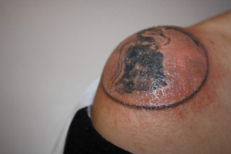 Wundwasser, Bläschen, Ausschlag nach 9 Tagen Was tun? Tattoo