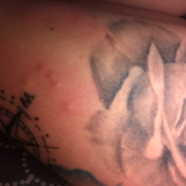 ComicGirl: Blasen, juckende Pusteln, schmerzhafte Krusten - Allergie?