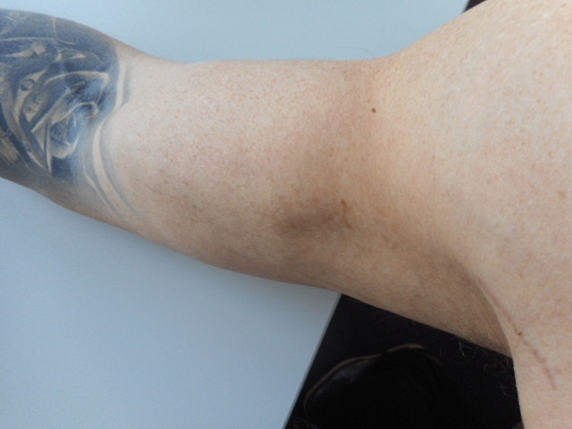 hotknife: Arm nur Innenseite komplett?