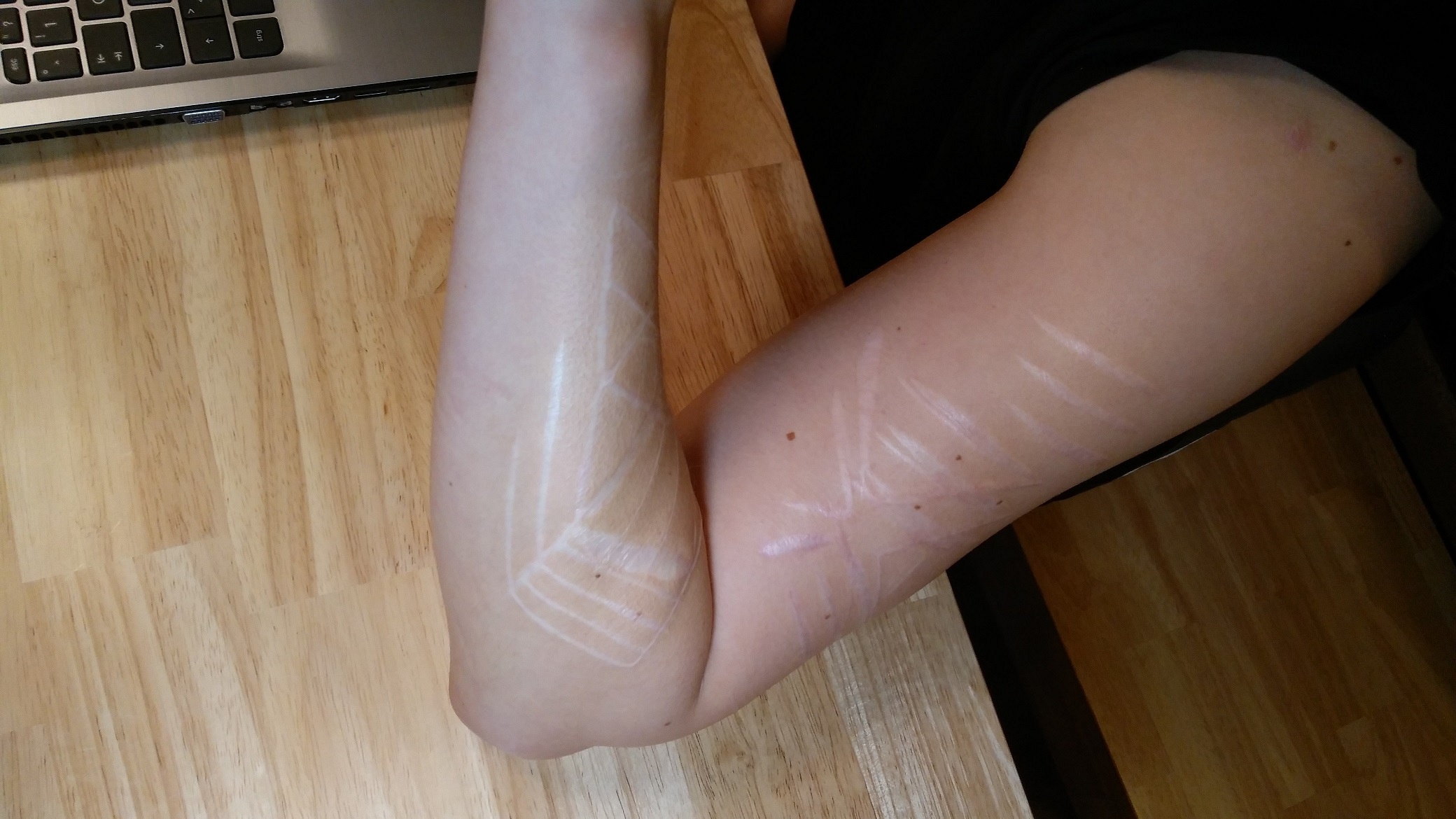 Luna Tic: Tattoo & Tiefe Narben...Rat & Empfehlungen von Euch