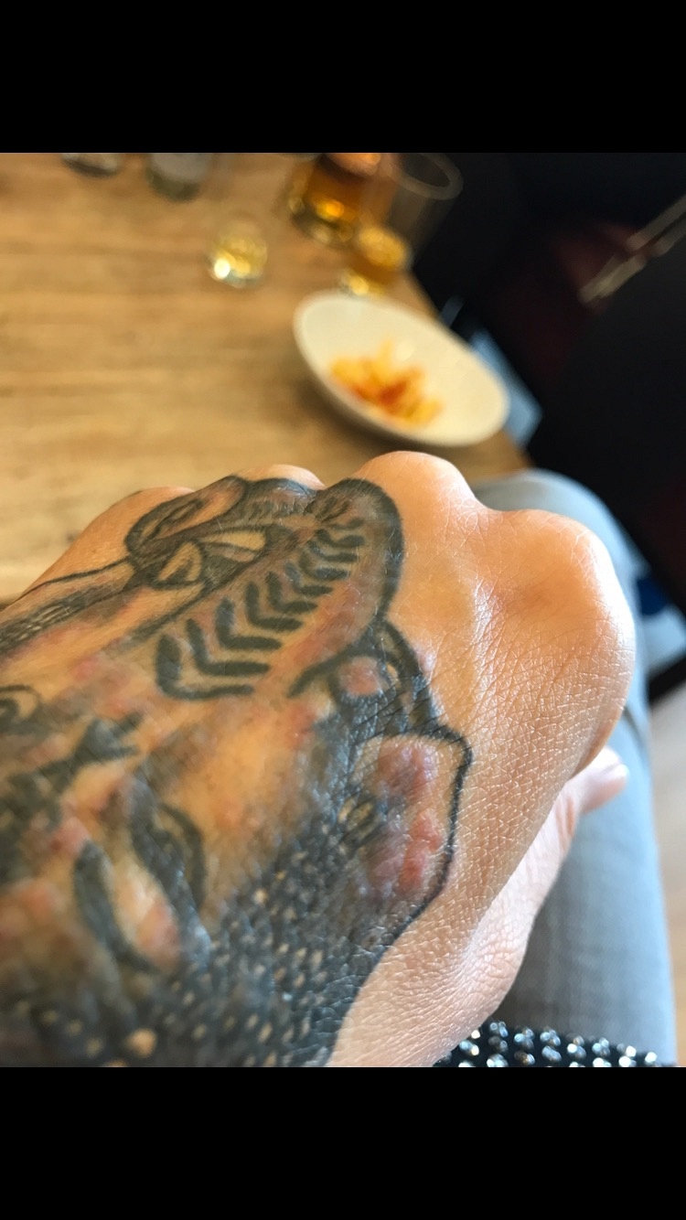 Xandi11: Tattoo heilt nicht?!