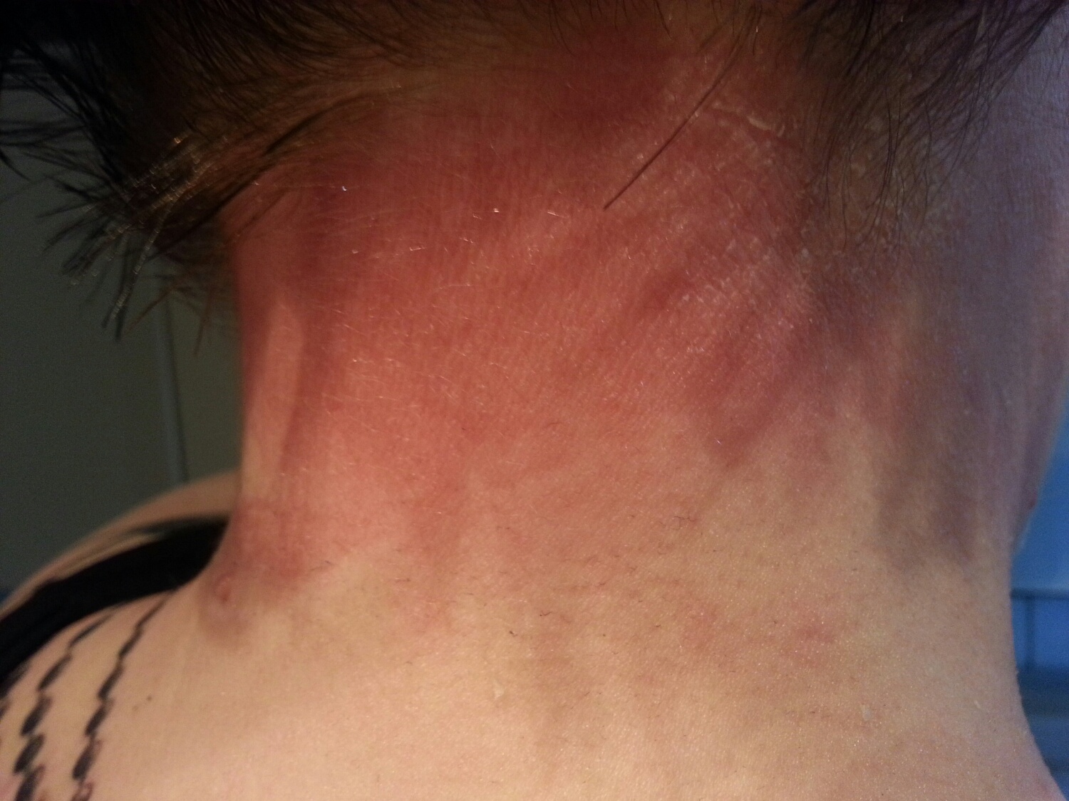 kaha41: was ist es? allergische Reaktion?