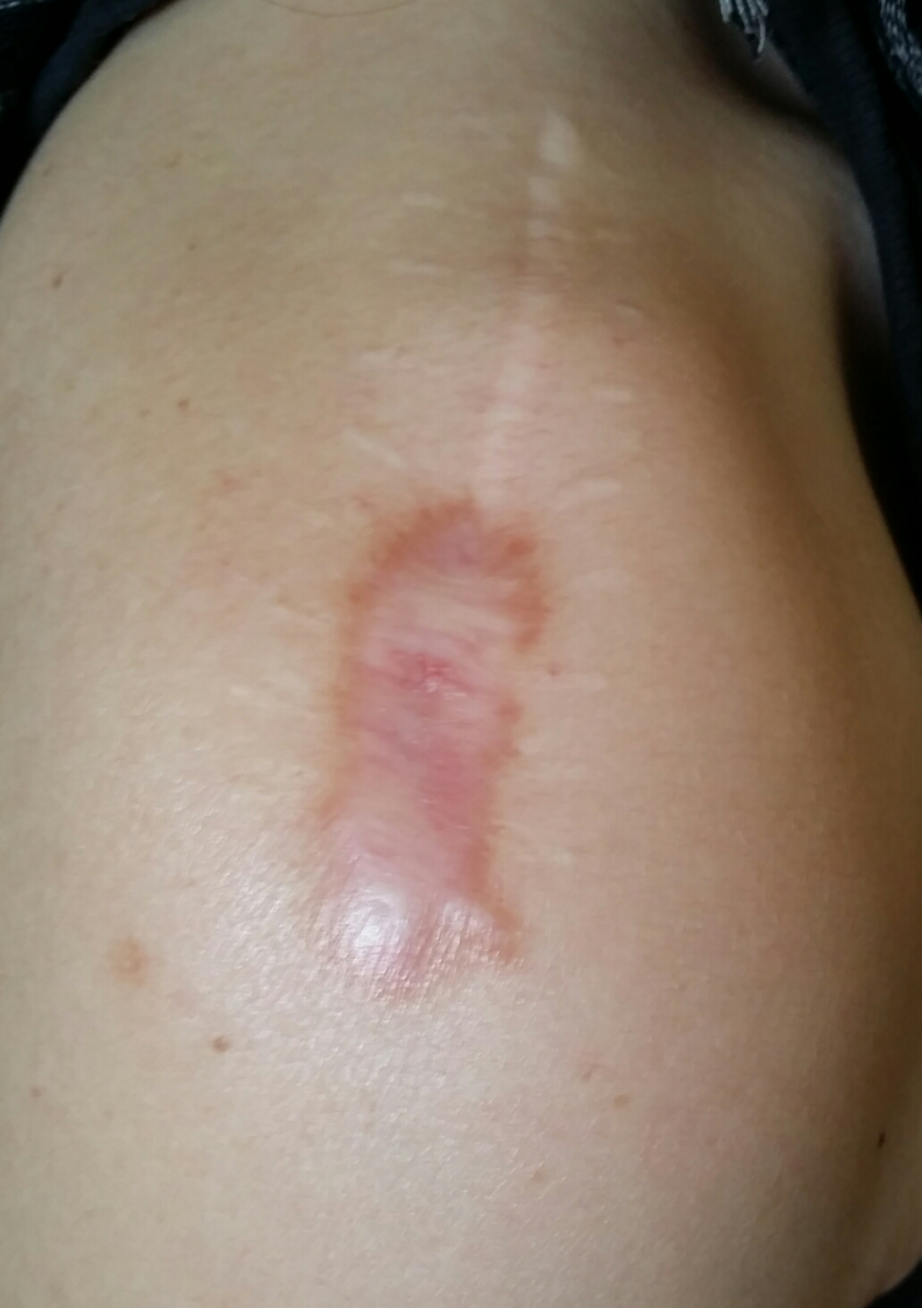 Pixels: Tattoo vs. Narbe