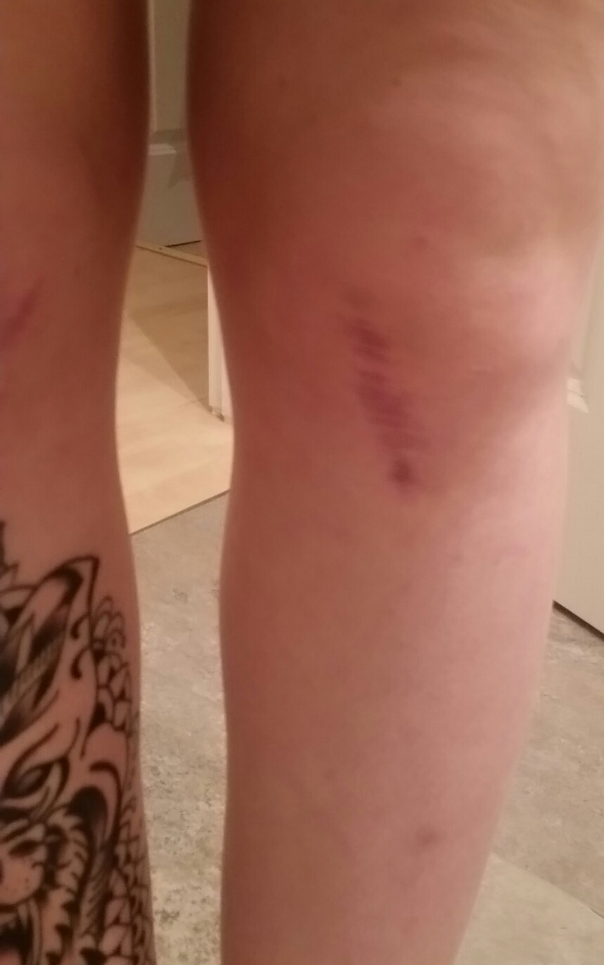 Inkme: Knie Tattoo - Narbencover
