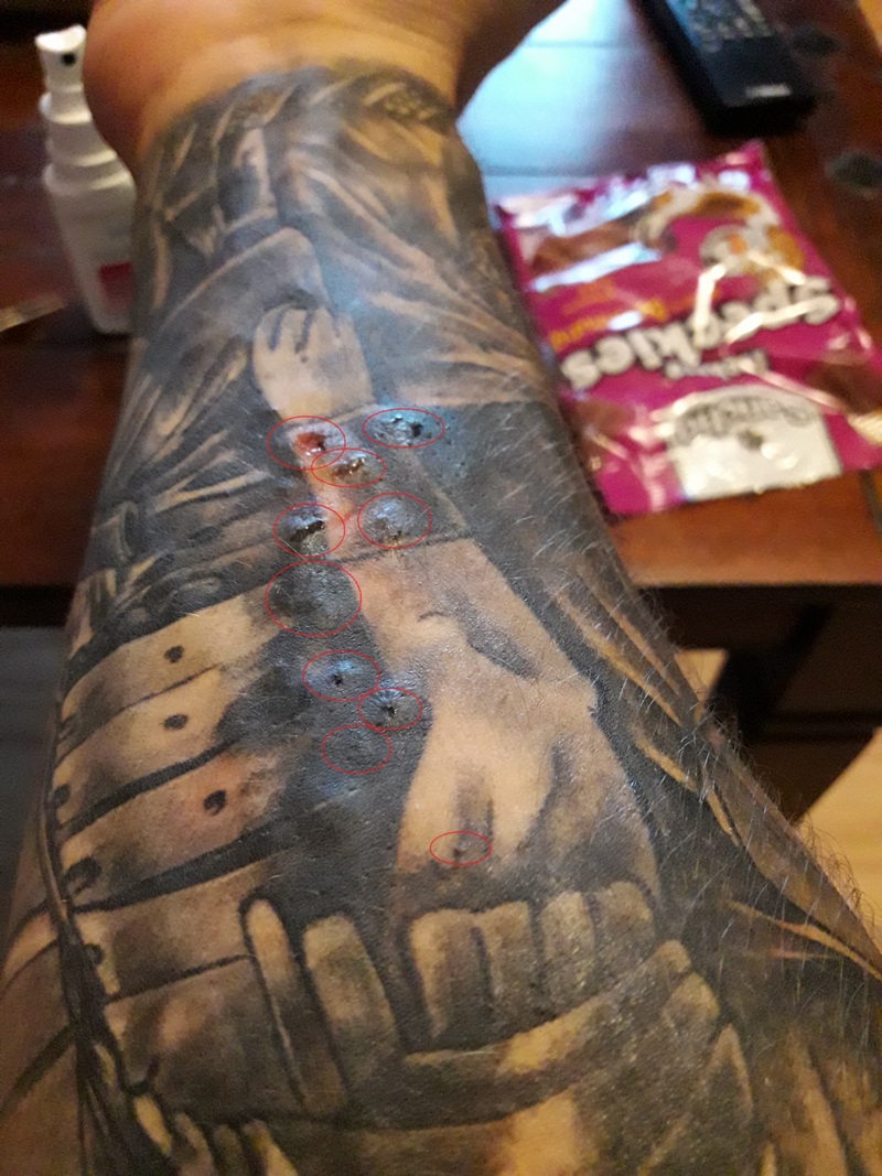 Ragnar: Tattoo hat Blasen .Allergie ? 