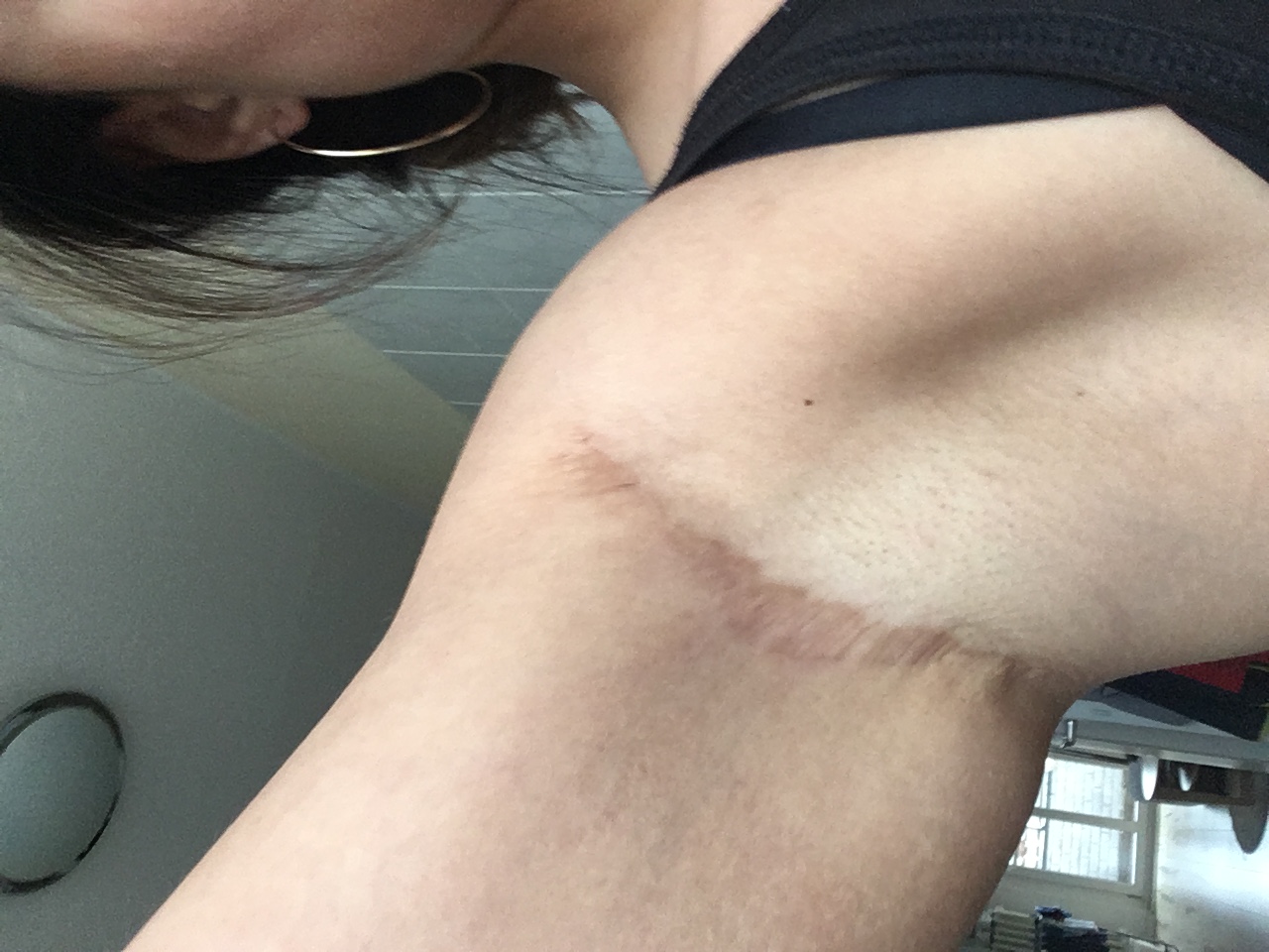 HilfeNarbe1214: Tattoidee für die Achsel - Narbencover