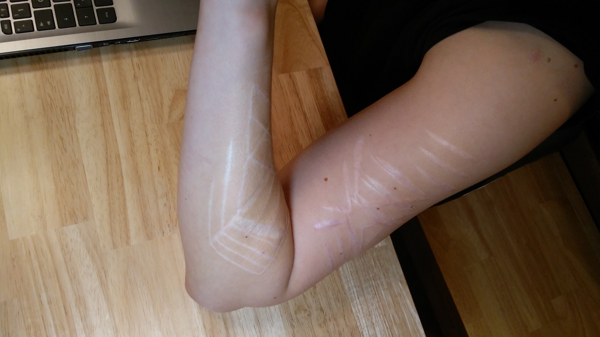 Luna Tic: Tattoo & Tiefe Narben...Rat & Empfehlungen von Euch